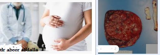 تظهر المشيمة من النساء الحوامل المصابات بـ COVID-19 إصابة