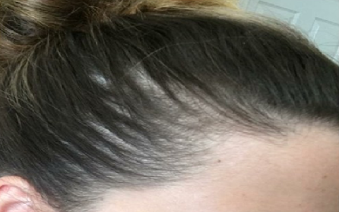 Female Baldness Treatment Causes And Prevention Healthywd