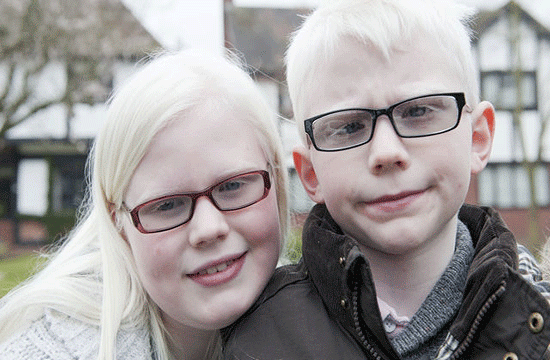 Por Una Visión Saludable: ¿Por qué el Albinismo afecta la visión?