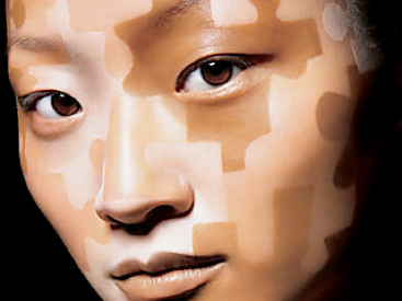 what causes vitiligo