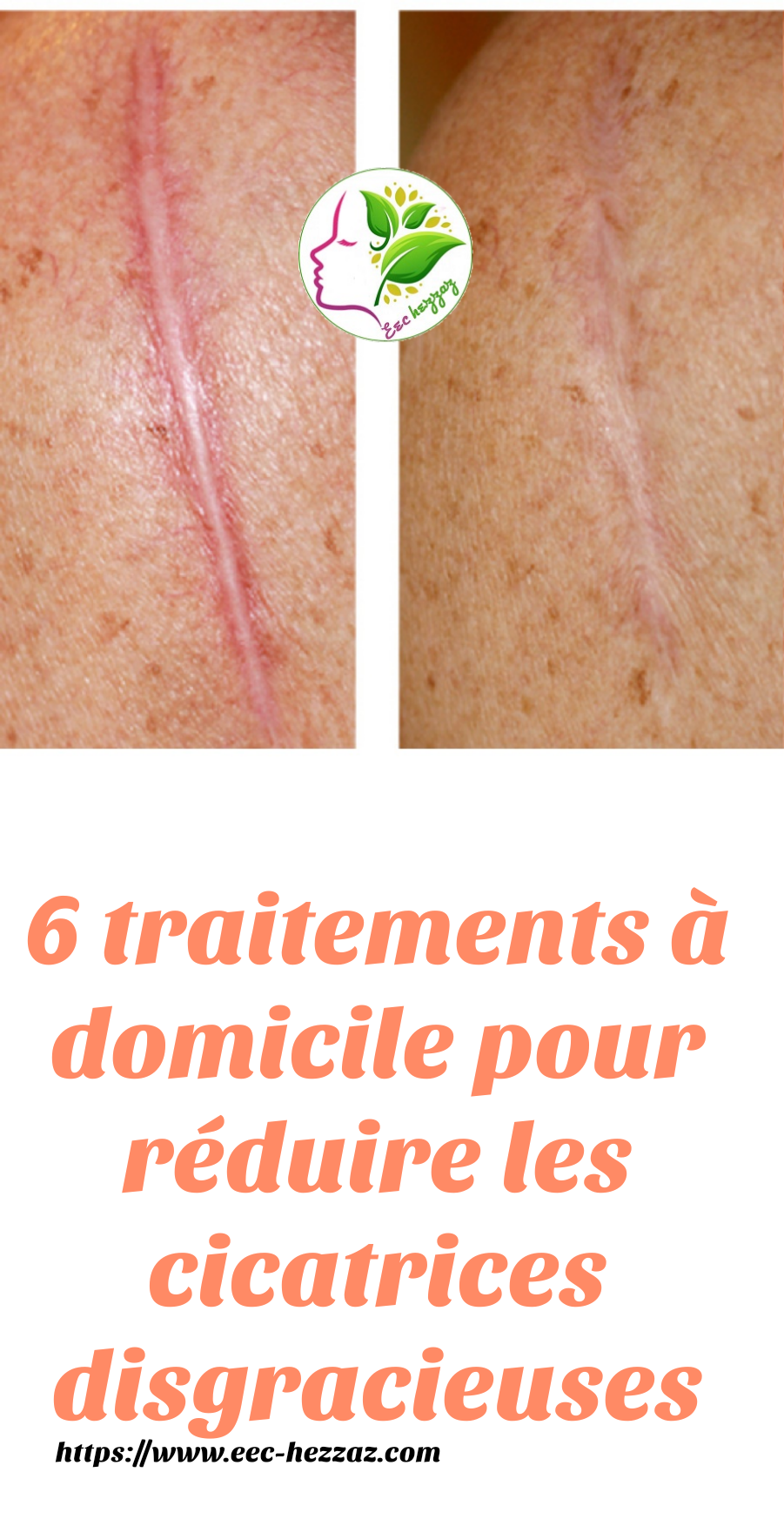 6 traitements à domicile pour réduire les cicatrices disgracieuses