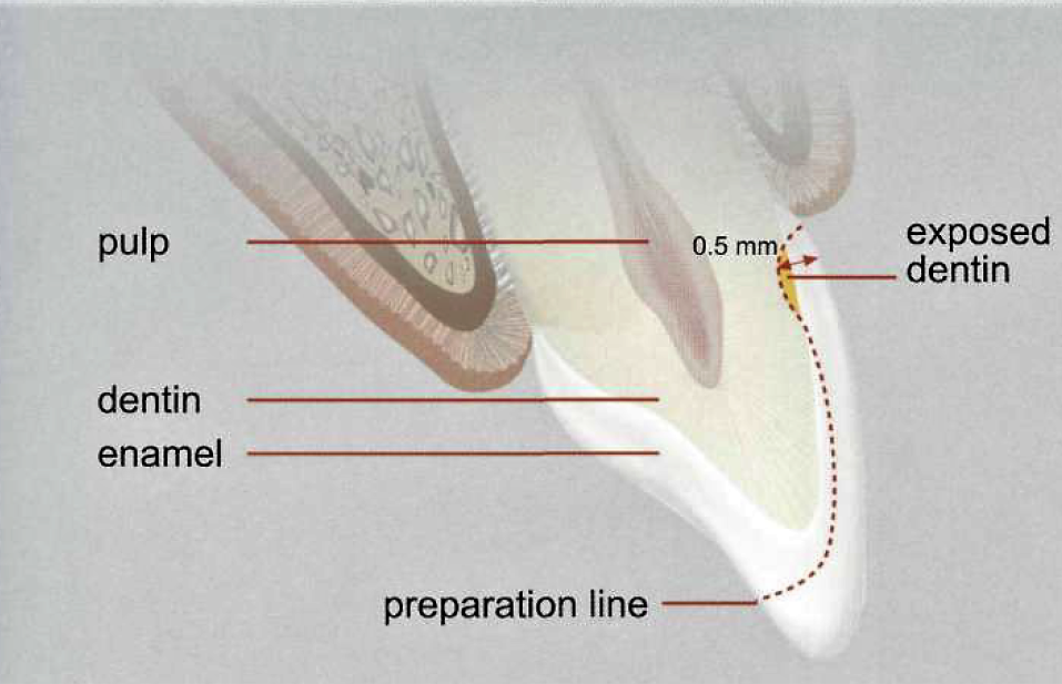 Ceramic veneers preparation .. Part 4 "Special cases" Dental Esthetics