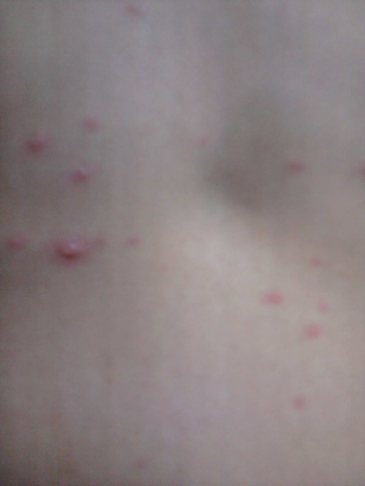 Rashes like chicken pox ? - Answered by top doctors on ...