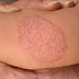 Candidiasis, Moniliasis, Cryptococcosis, Aspergillosis