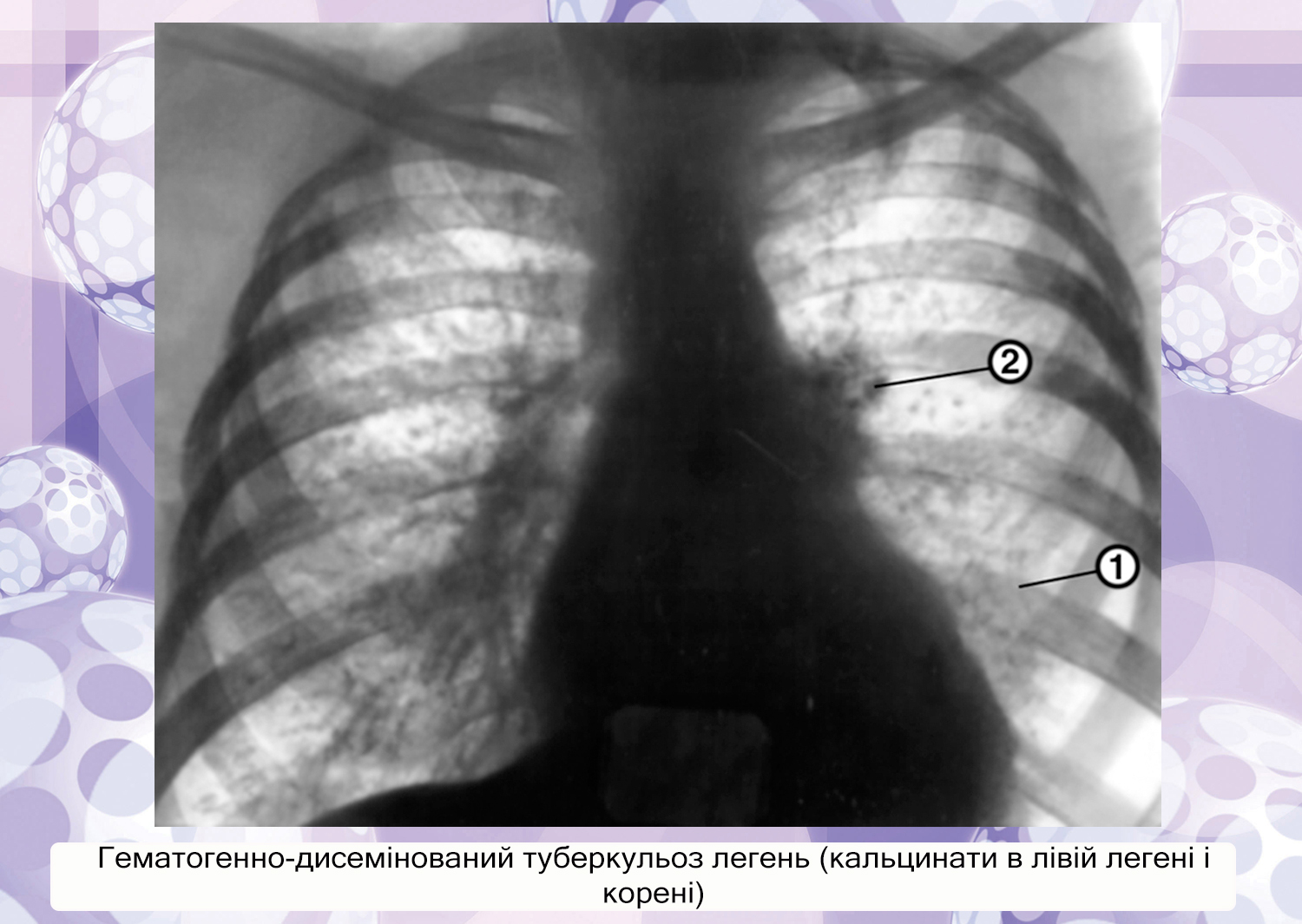Туберкулез легкого рентгенограмма. Рентген грудной клетки туберкулез. Диссеминированный туберкулез флюорография. Флюорография органов грудной клетки туберкулез.