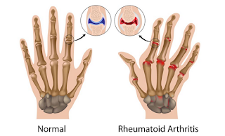 Pengobatan Terapi Lintah untuk Mengobati Arthritis