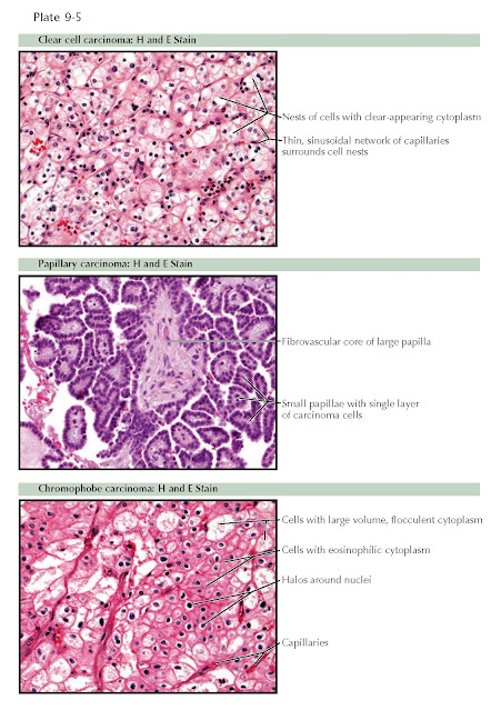 HISTOPATHOLOGIC FINDINGS IN RENAL CELL CARCINOMA