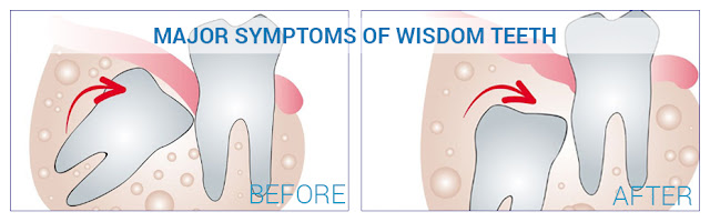 Major Symptoms of Wisdom Teeth