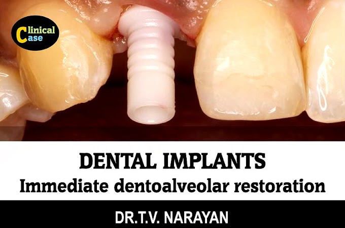 DENTAL IMPLANTS: Immediate Dentoalveolar Restoration Technique - Dr.T.V. Narayan
