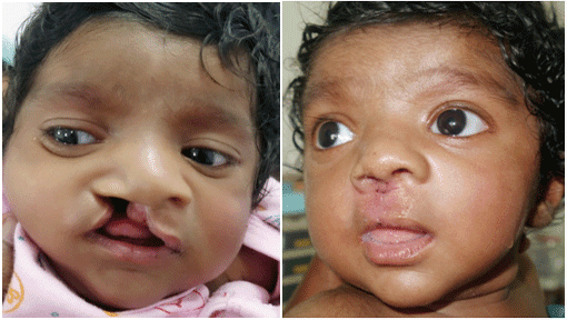 Cheiloplasty - Richardson dental and craniofacial Hospitalposts