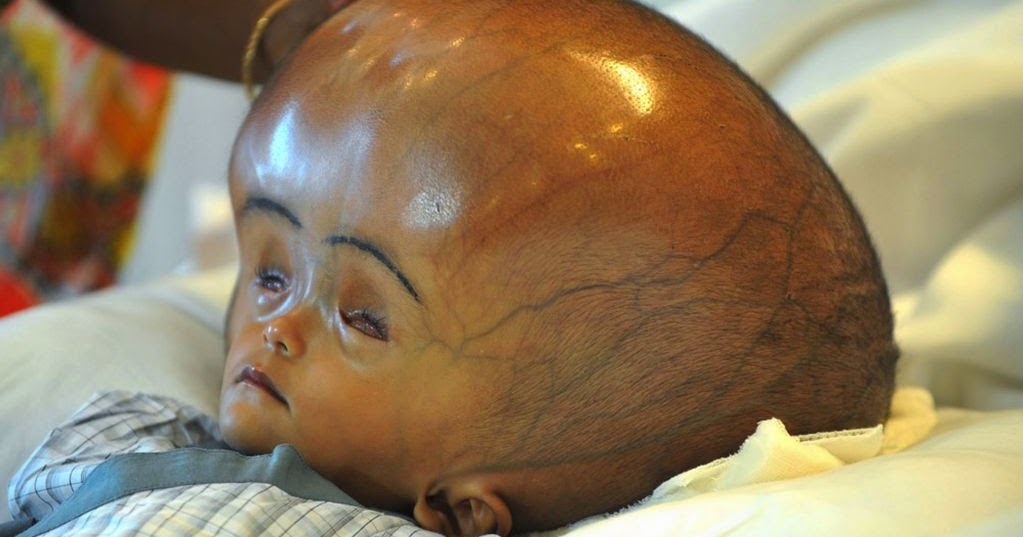 Hydrocephalus Causes, Symptoms and Prevention PublicWellness Group