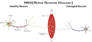 how detect mnd,types of motor neuron disease,stages of mnd,about motor neuron disease