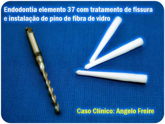 PINOS DENTARIOS: Endodontia elemento 37 com tratamento de fissura e instalação de pino de fibra de vidro - Caso Clínico