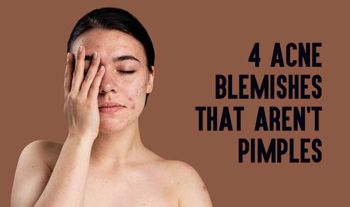 4 Acne Blemishes That Aren't Pimples