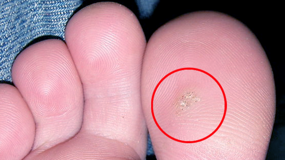 warts skin feet