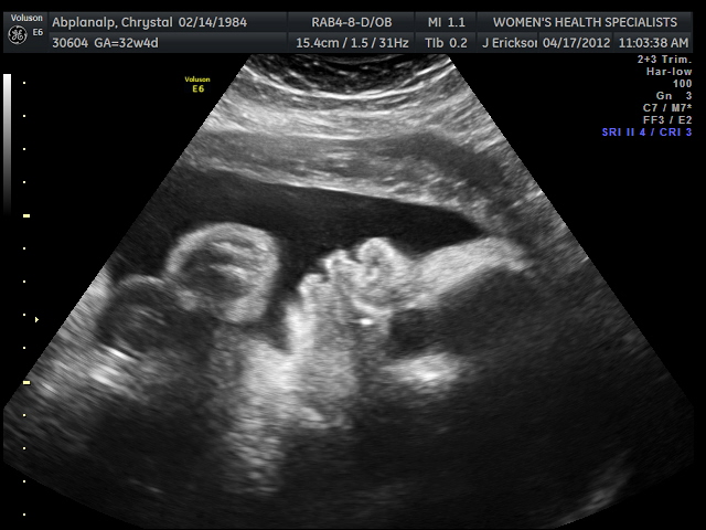 32 Weeks Ultrasound