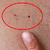 LOOK WELL AT THESE TWO MOLES! IF YOU HAVE THEM YOU SHOULD KNOW THAT ONE OF THEM IS A POTENTIAL CANCER! (A PHOTO)