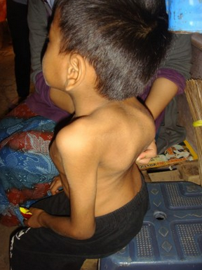 Cerita Ibu Muda Penderita Tbc Tulang Belakang Bangkit Dari