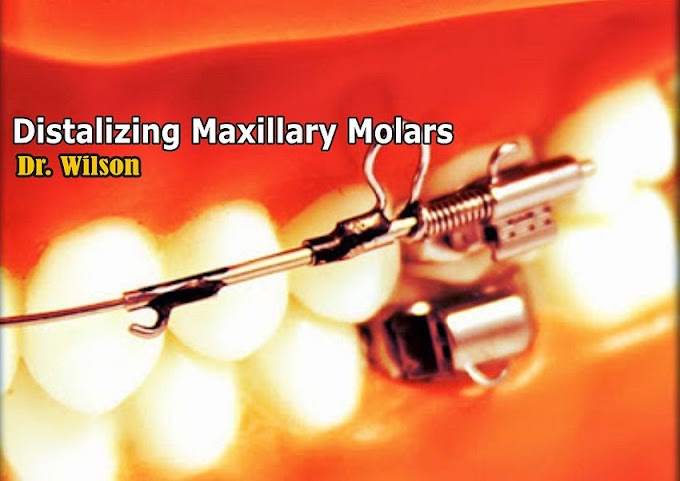 ORTHODONTICS: Distalizing Maxillary Molars - Dr. Wilson