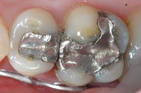 Vật liệu trám răng truyền thống amalgam