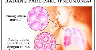 Cara Mengobati Pneumonia Secara Alami