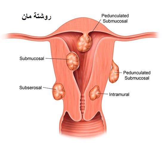 الياف الرحم | الالياف في الرحم الياف الرحم | الالياف في الرحم