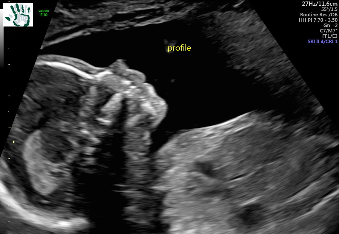 It's MY LIFE Pregnancy Update 9 Second Trimester Ultrasound