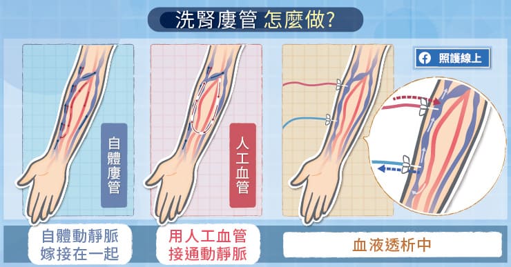 洗腎廔管怎麼做？