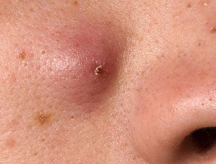 Various type Of Acute acne