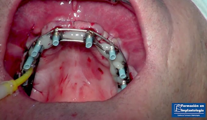 IMPLANTES Post-Extracción en toda la boca: Electrosoldadura intraoral - Carga inmediata