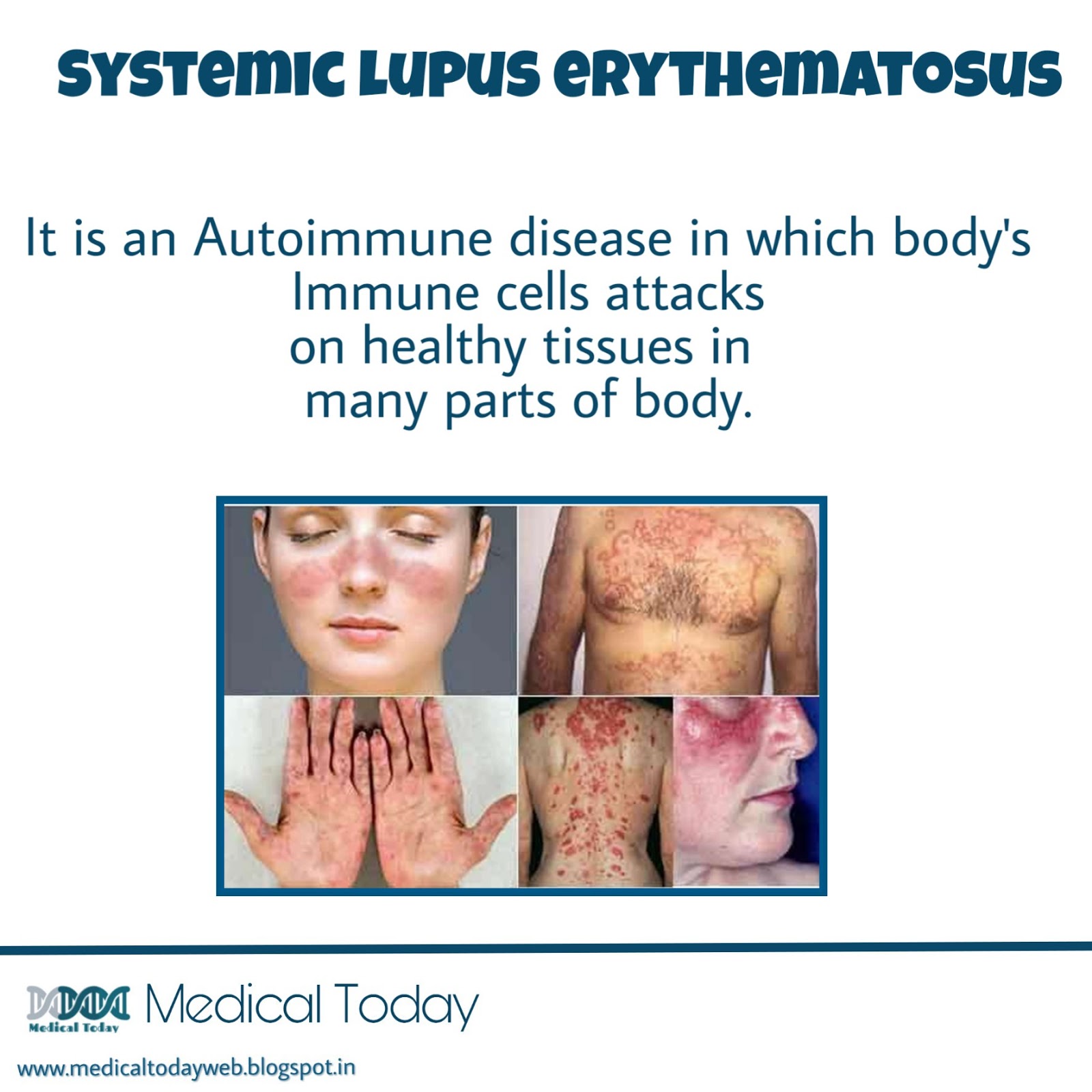 SLE Lupus - Dr.PrakashPaymode