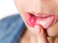 Cara Menyembuhkan Sariawan di Pinggir Bibir