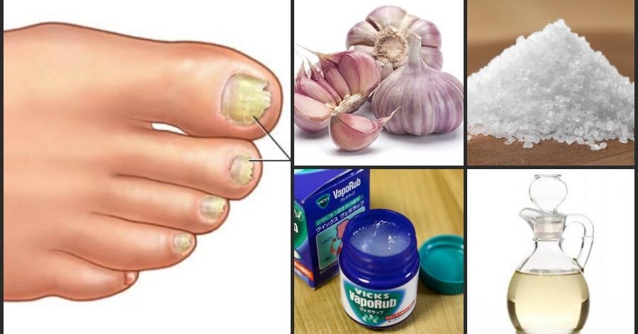 ¡Elimina el Hongo de las Axilas de Forma Efectiva!_3 Como matar el hongo de las axilas_3