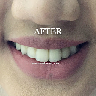 Review Foto Before After Crest 3D Whitestrips Teeth Whitening Kit