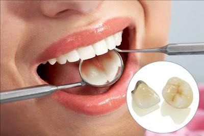Duy trì kết quả bọc răng sứ titan được bao lâu? 2