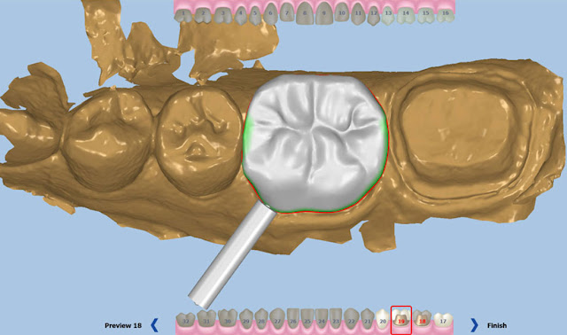 dental cad cam designing