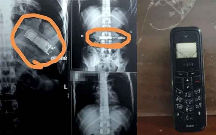 News, World, Cairo, hospital, Youth, Mobile Phone, Mobile phone and foreign currency were taken out of the patient's stomach