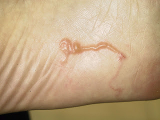 infeccion con parasito en la piel