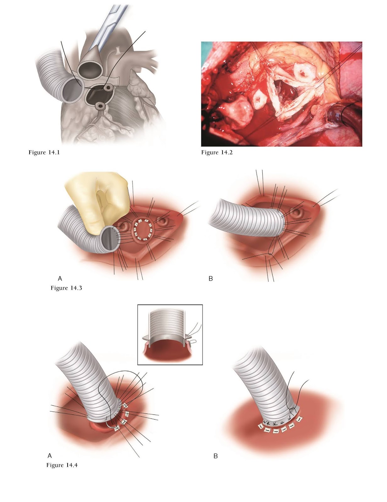 case study bentall procedure