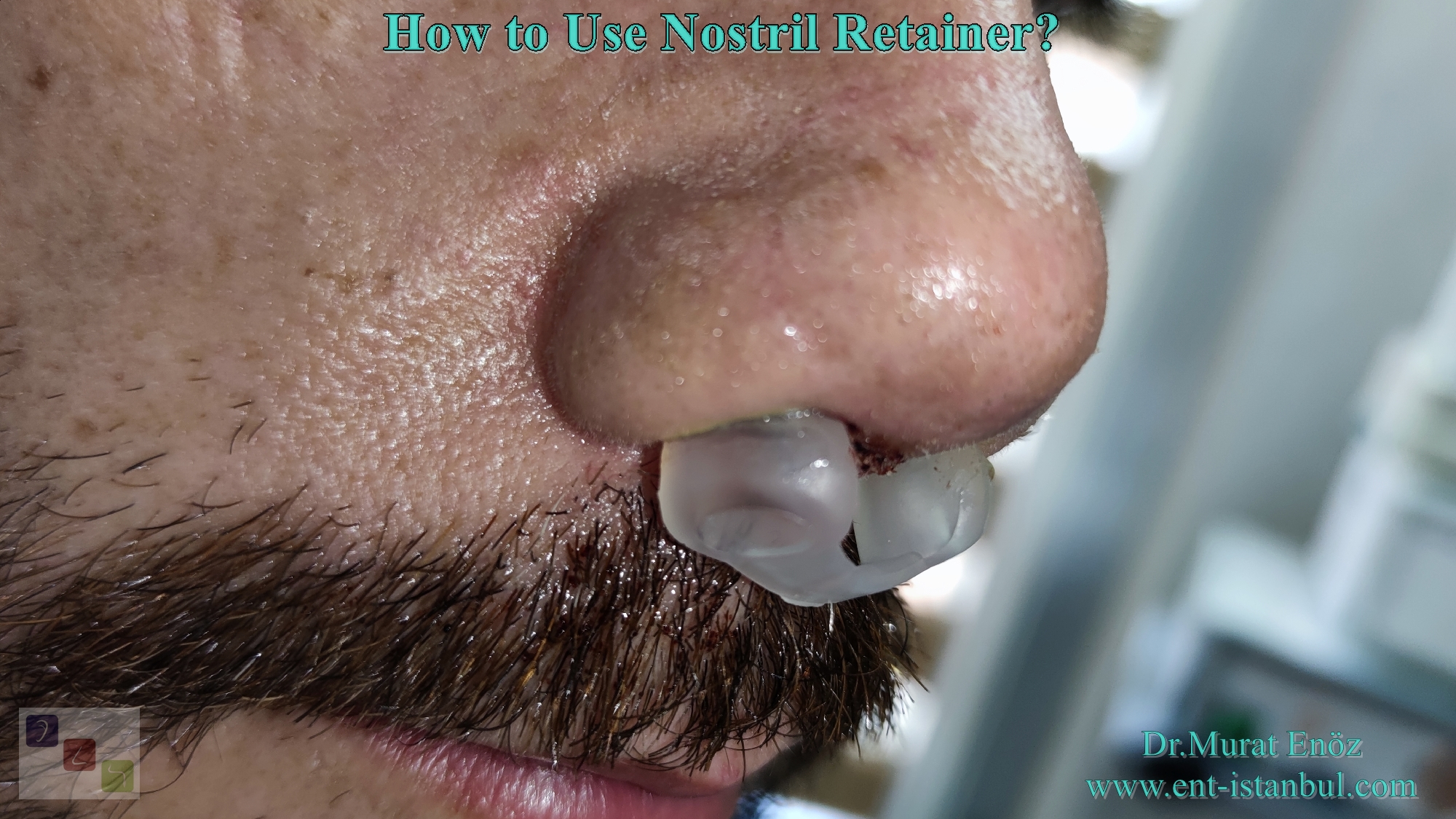 About The Nostril Retainer