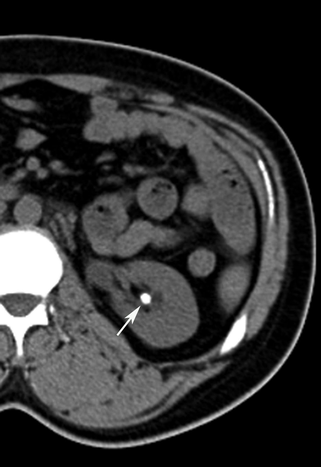 Radiodiagnosis Imaging is AmazingInteresting cases Renal calculus