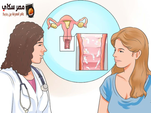 أعراض إلتهاب عنق الرحم وكيفية الوقاية والعلاج Cervix Inflammation