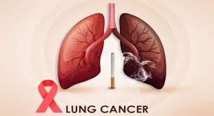 Lung Cancer: Symptoms, Causes, Diagnosis And Treatment.