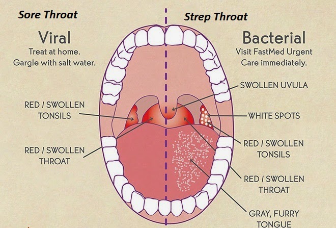 Mono Strep Throat 30