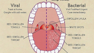 Radang Tenggorokan Setelah Operasi Amandel