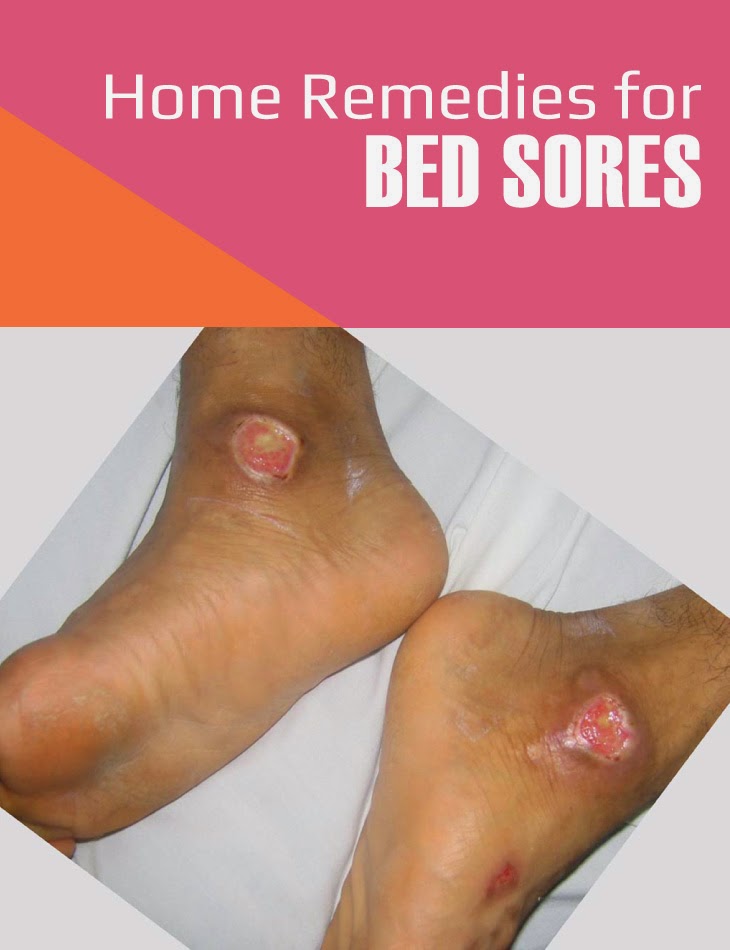 Home Remedies For Bed Sores Tips Park