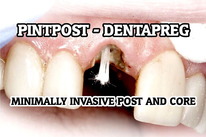 PINTPOST: Minimally Invasive Post and Core - Dentapreg