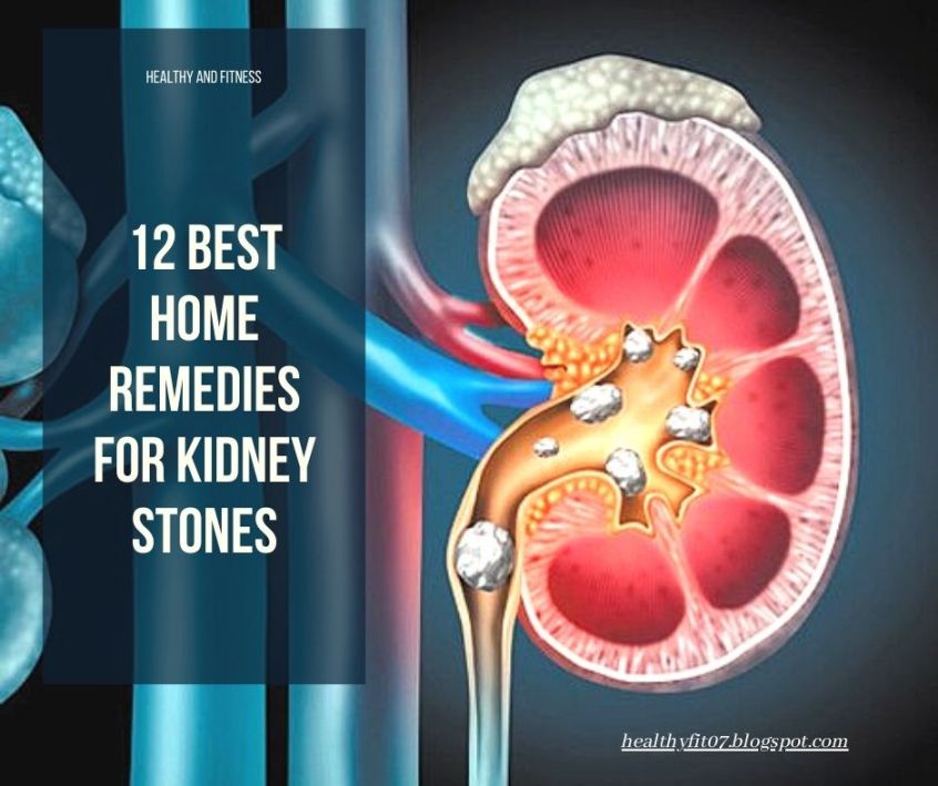 12 BEST HOME REMEDIES FOR KIDNEY STONES