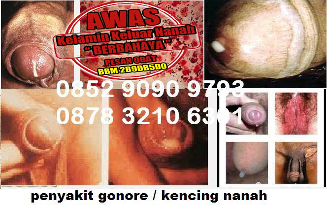 Cara Terapi Tradisional Kencing Nanah Mujarab Cara Terapi Tradisional Kencing Nanah Mujarab