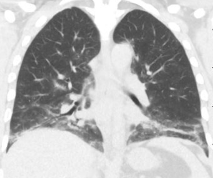 Horses and Zebras Dyspnea and Interstitial Lung Disease